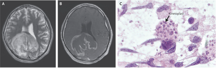 NEJM：大脑中弓形虫重新激活-病例报道