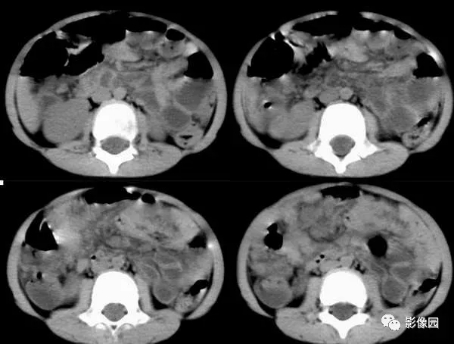 肠系膜海绵状淋巴管瘤合并急性阑尾炎CT病例！