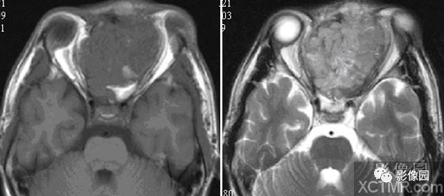 左侧鼻腔<font color="red">嗅神经</font>母细胞瘤MRI病例！