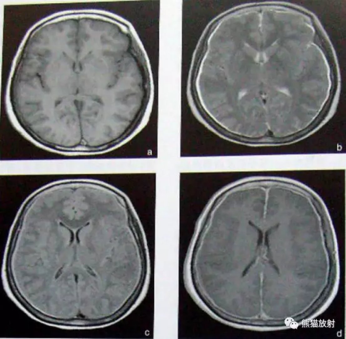 7种颅内感染性病变CT表现