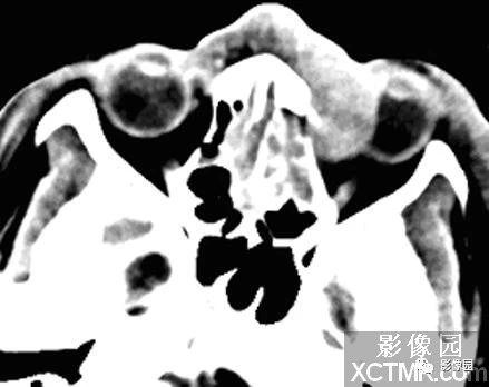 右侧鼻腔<font color="red">淋巴结</font>外NK/T细胞性<font color="red">淋巴瘤</font>(鼻型)CT病例！