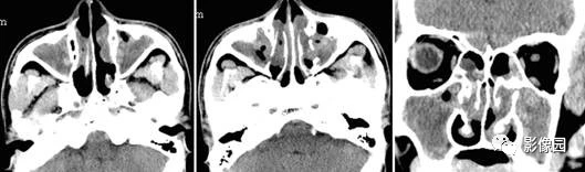 <font color="red">双</font>侧中鼻道及副鼻窦息肉(Polyp)CT病例！