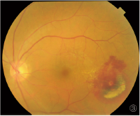 视网膜大动脉瘤1例