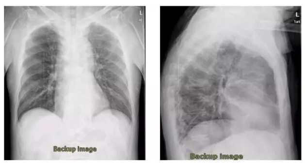 病例分享：慢阻肺急性加重患者综合治疗后胸背部疼痛