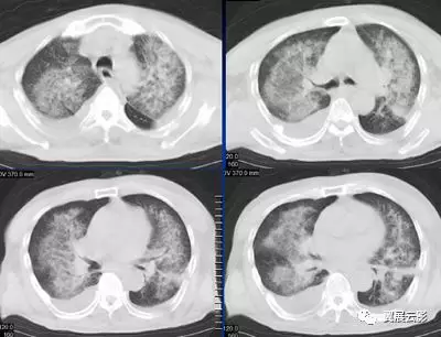 9种弥漫性肺泡实变影像的鉴别诊断