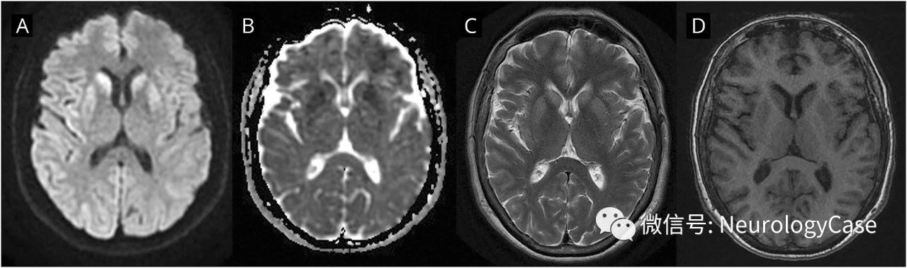 Neurology：病例：Creutzfeldt-Jakob病的<font color="red">DWI</font>和脑电图表现