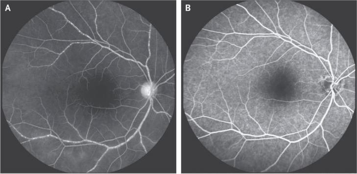 NEJM：Takayasu动脉炎的视网膜血管炎-病例报道
