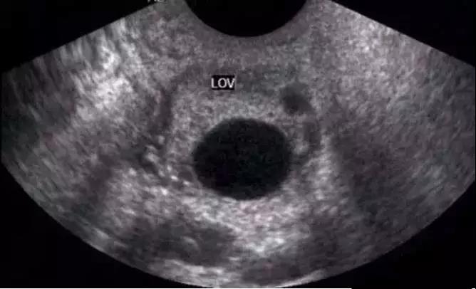 阴道B超在排卵监测中的运用