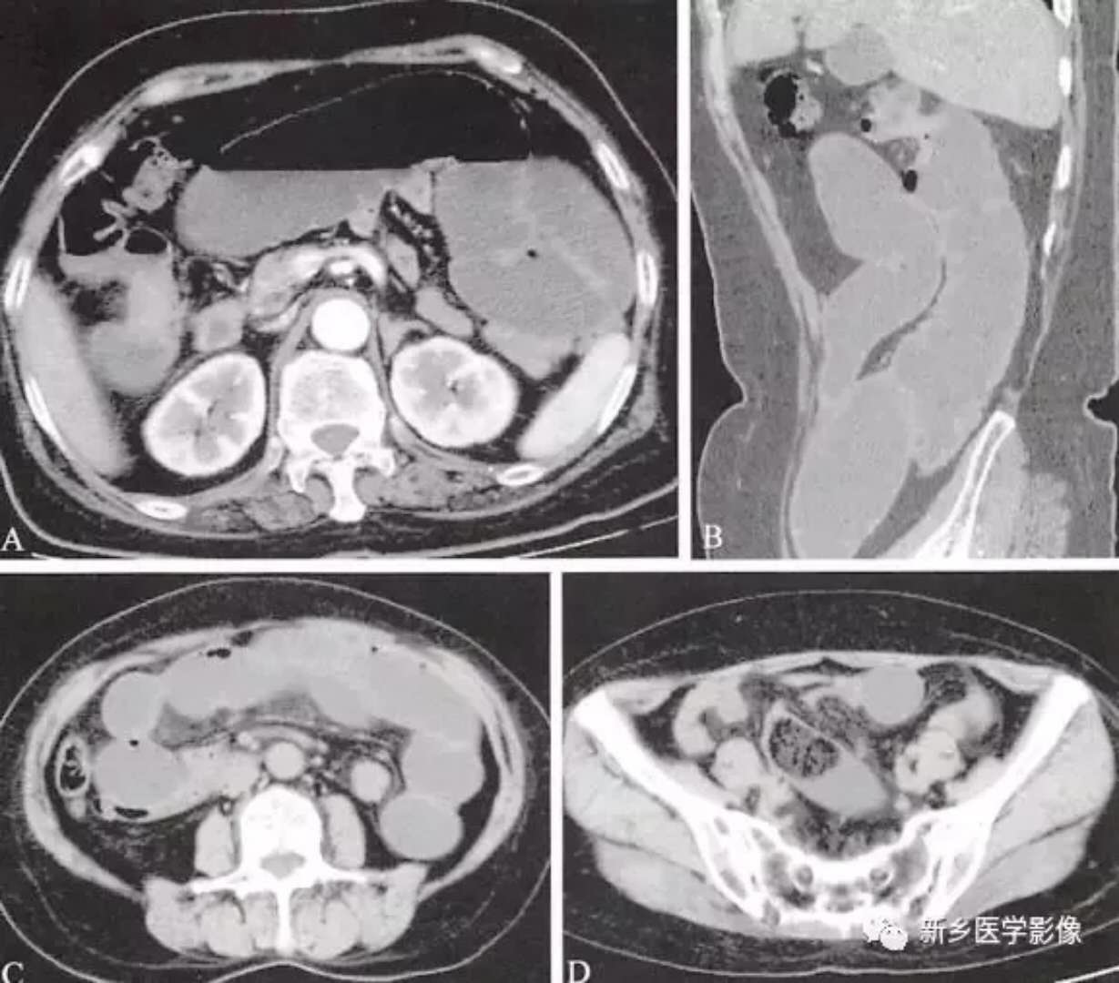 非外伤性3种急腹症的CT分析