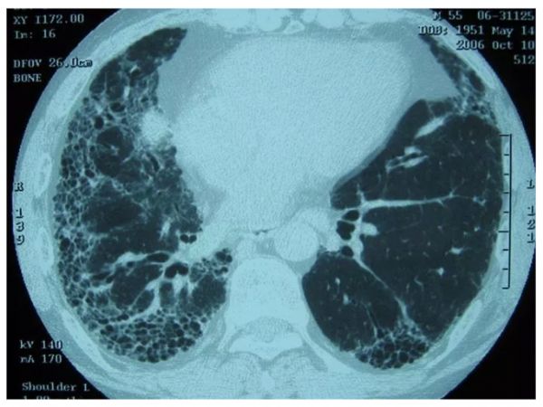 罕见病解读系列（1）| 代华平：特发性肺纤维化会造成哪些临床表现与病理改变？如何诊断与鉴别诊断？