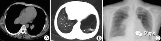慢性肺源性心脏病X线-CT病例影像诊断分析！
