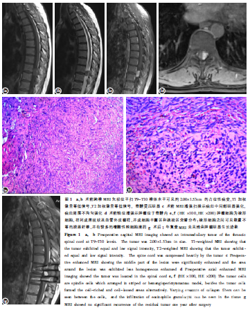 脊髓髓内孤立性纤维性肿瘤1例