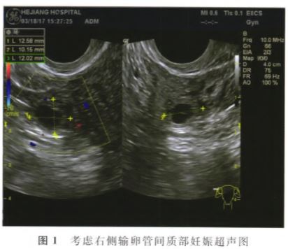 双侧输卵管切除术后输卵管残端外异位妊娠1例