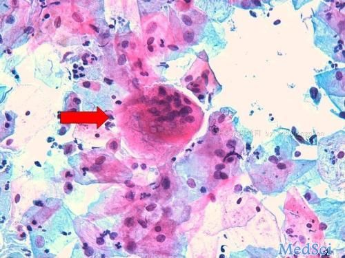 Oncogenesis：HBx通过HIF-1α/LOX通路<font color="red">重建</font>ECM以促进肝细胞癌的转移