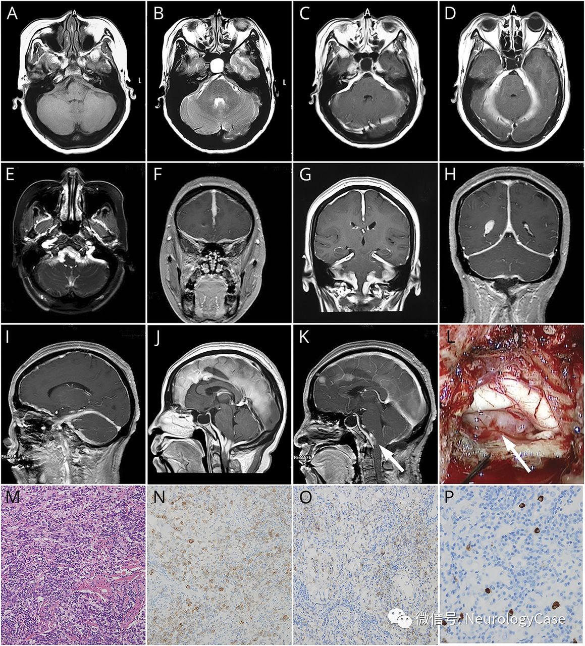 Neurology：累及整个<font color="red">颅</font>内硬脑膜的富于淋巴浆细胞型脑膜瘤