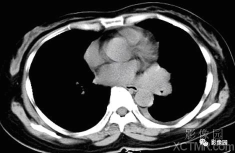 左侧中央型肺癌CT病例！