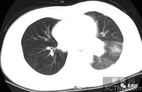中心型肺癌ct图片图片