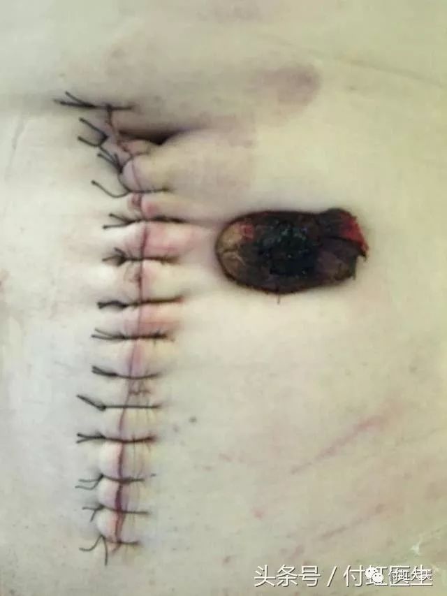 胃手术的伤口照片图片