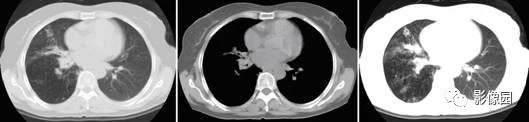 肺结核CT病例！