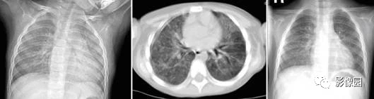 支气管肺炎X线-CT病例！