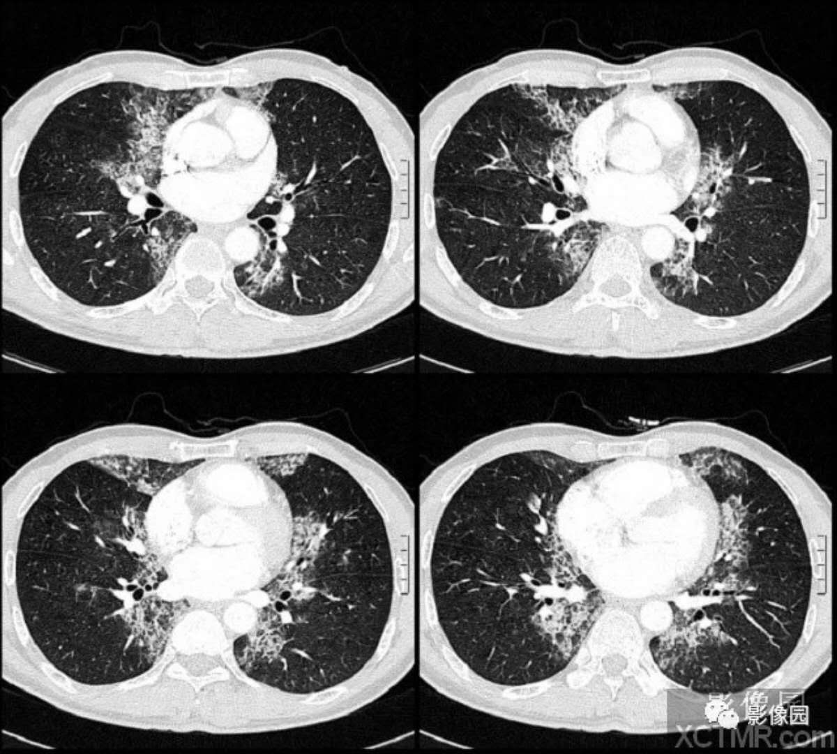 肺泡蛋白沉着症CT病例！