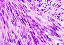 Lancet oncol：标准化疗方案IVA联合强化<font color="red">阿霉素</font>治疗横纹肌肉瘤的效果和安全性！