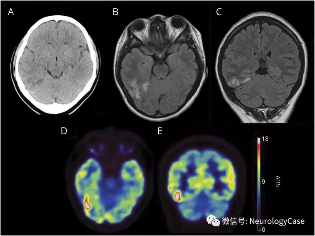 Neurology:面孔失认可提示抗NMDA受体脑炎