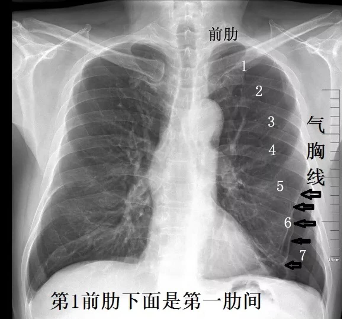 ct片怎么看肺大泡图片,肺大泡t图片,肺大泡t图片解读_大山谷图库