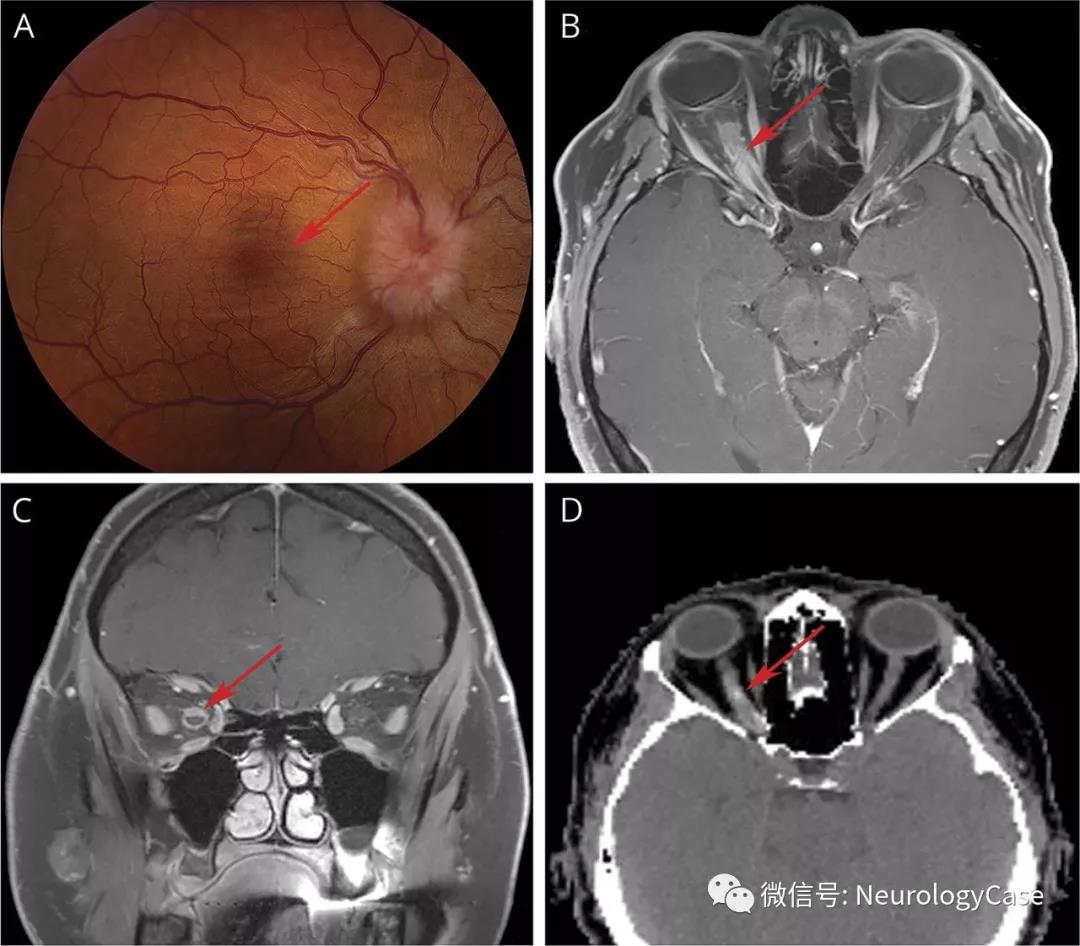 Neurology：表现为凝视诱发性黑朦的视神经鞘脑膜瘤
