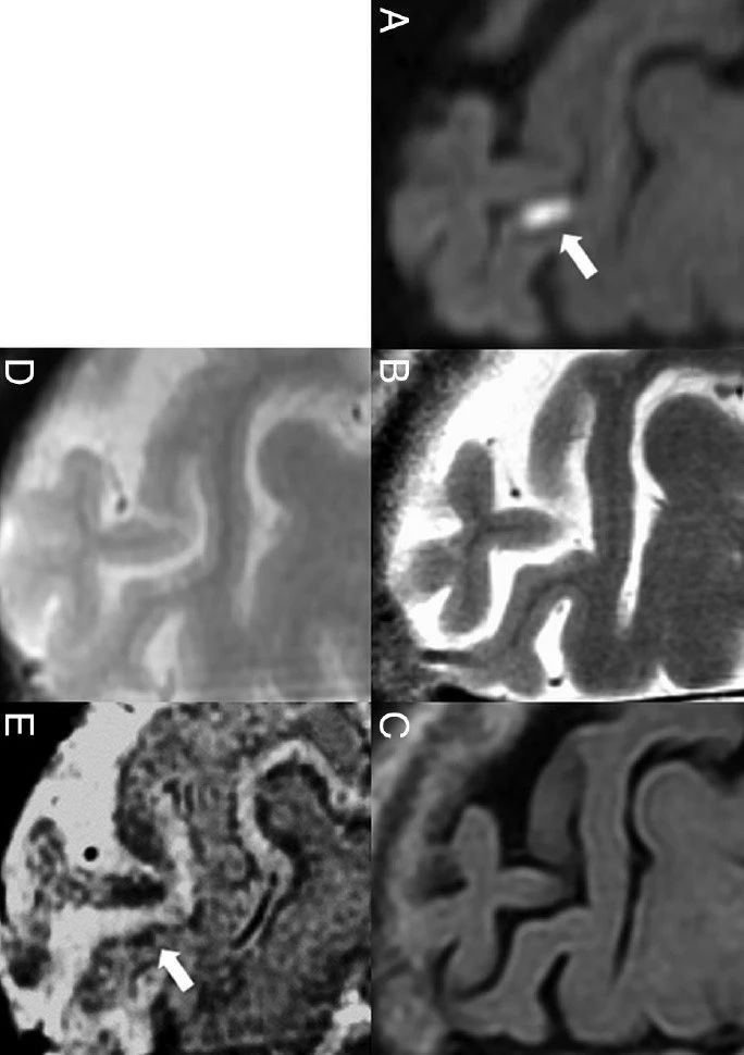 Am J Neuroradiol：急性皮质和近皮质微梗死的MRI信号演变