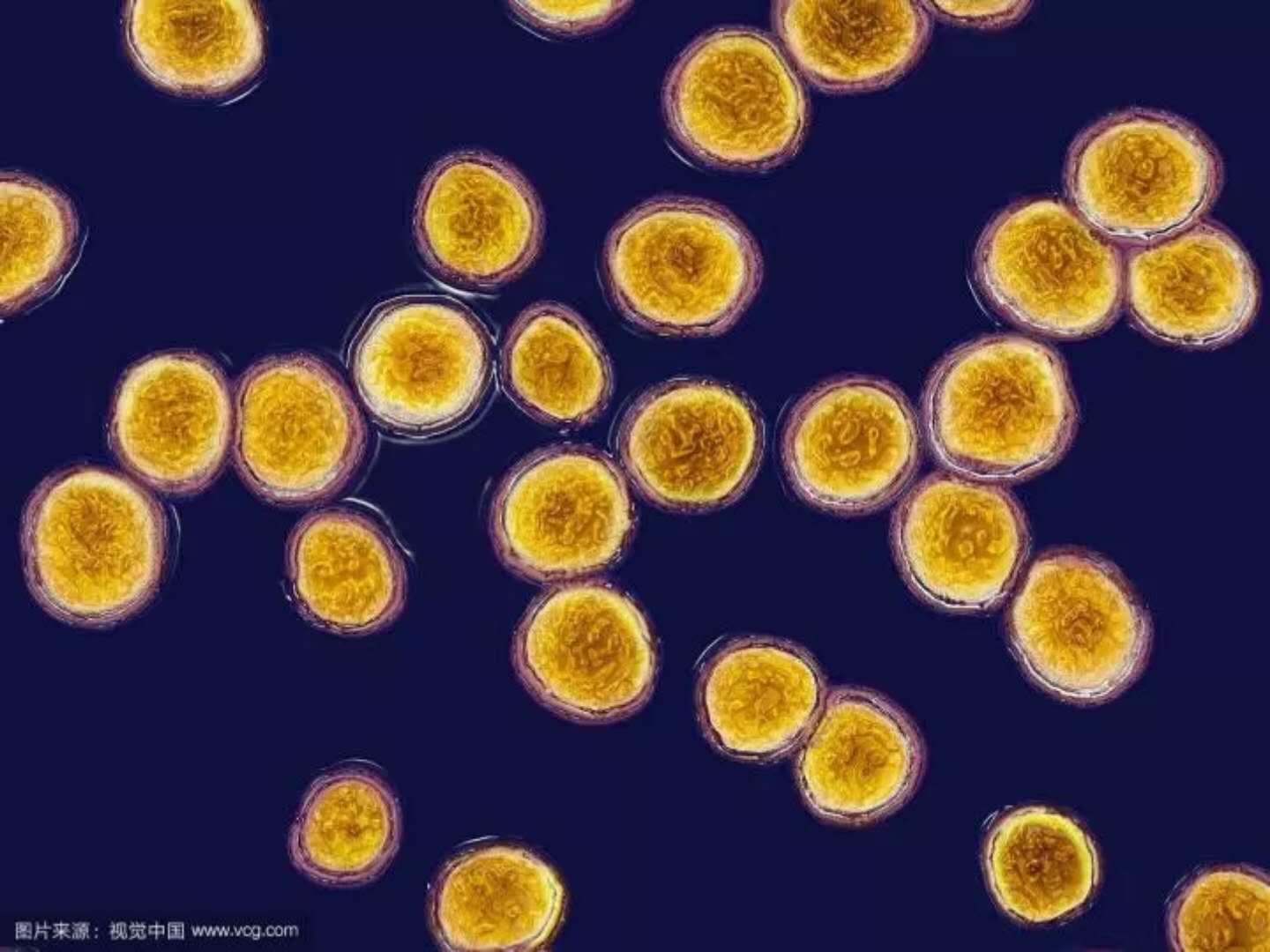 金黄色葡萄球菌肺炎，大咖教你看CT片！