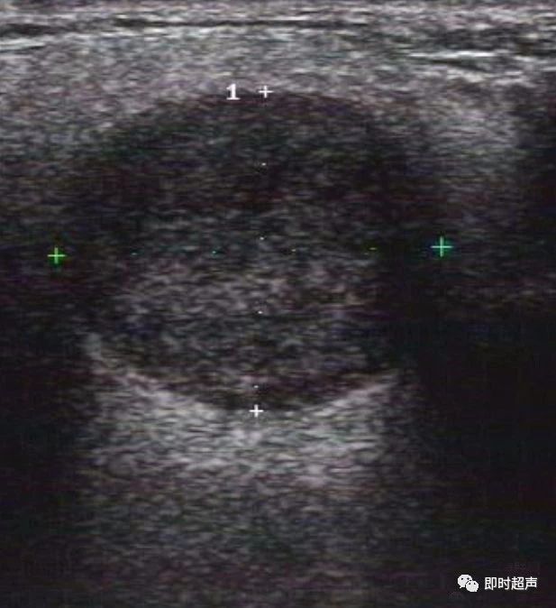 腮腺混合瘤彩超图片图片