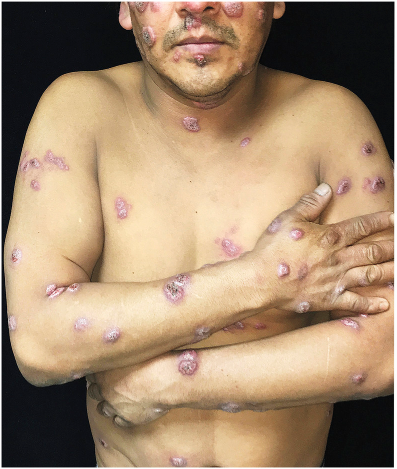 NEJM：播散性皮肤芽生菌病-病例报道