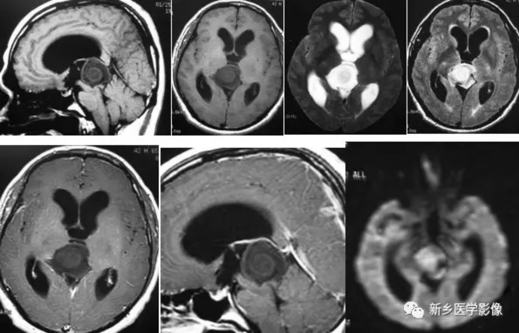 12种松果体区肿瘤的影像表现