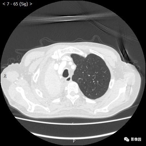 中央型肺癌1例