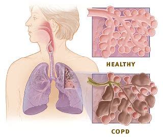 Plerixafor可以预防与烟雾有关的<font color="red">COPD</font>症状