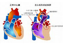 Circulation：严重主动脉瓣狭窄患者的心肌瘢痕与死亡率