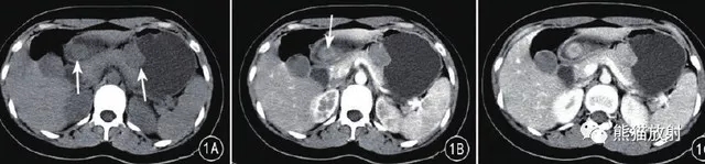 胃间质瘤和胃神经鞘瘤的CT鉴别诊断