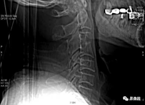 第3、4颈椎体阻滞<font color="red">椎</font>CT病例图片影像诊断分析！