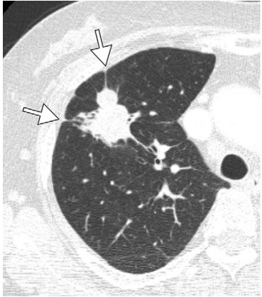 Radiology：对EGFR-<font color="red">TKI</font>治疗后<font color="red">耐药</font>的非小细胞肺癌中T790M突变阳性患者胸部CT特征的研究