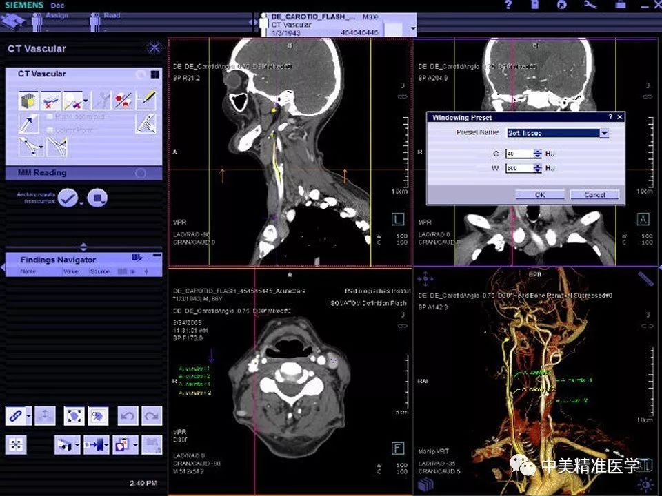 NIH共享3.2万份CT影像数据资料，可以训练AI了