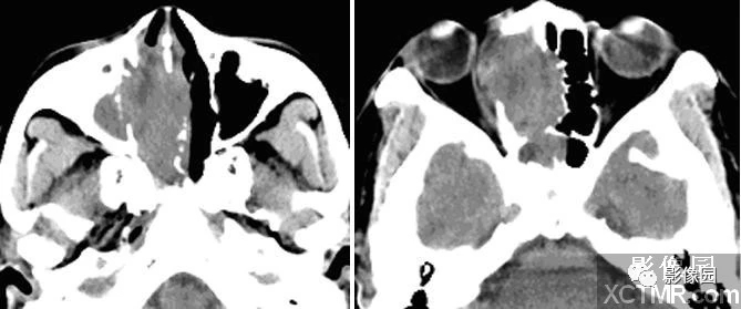 鼻腔低<font color="red">分化</font>鳞状细胞癌CT病例！