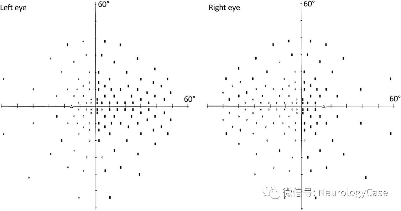 Neurology:Meyer环和外侧<font color="red">膝</font><font color="red">状</font><font color="red">体</font>连续病变后出现的特殊视觉病感失认