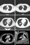 Medicine：原发性肺血管肉瘤的影像学检查结果——病例报道