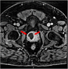 J Investig Med High Impact Case Rep：社區(qū)獲得耐<font color="red">甲</font>氧西林金黃色葡萄球菌感染引起的前列<font color="red">腺</font>膿腫