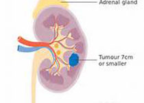 2018 ESE临床实践指南：成人<font color="red">肾上腺皮质</font><font color="red">癌</font>的管理