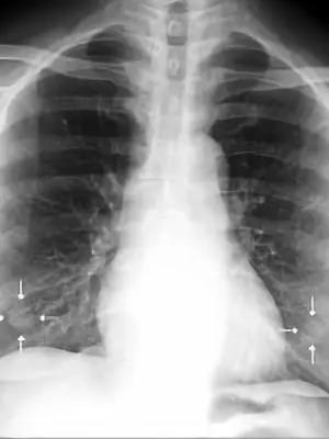 多次胸部X线误判为乳头影漏诊肺癌