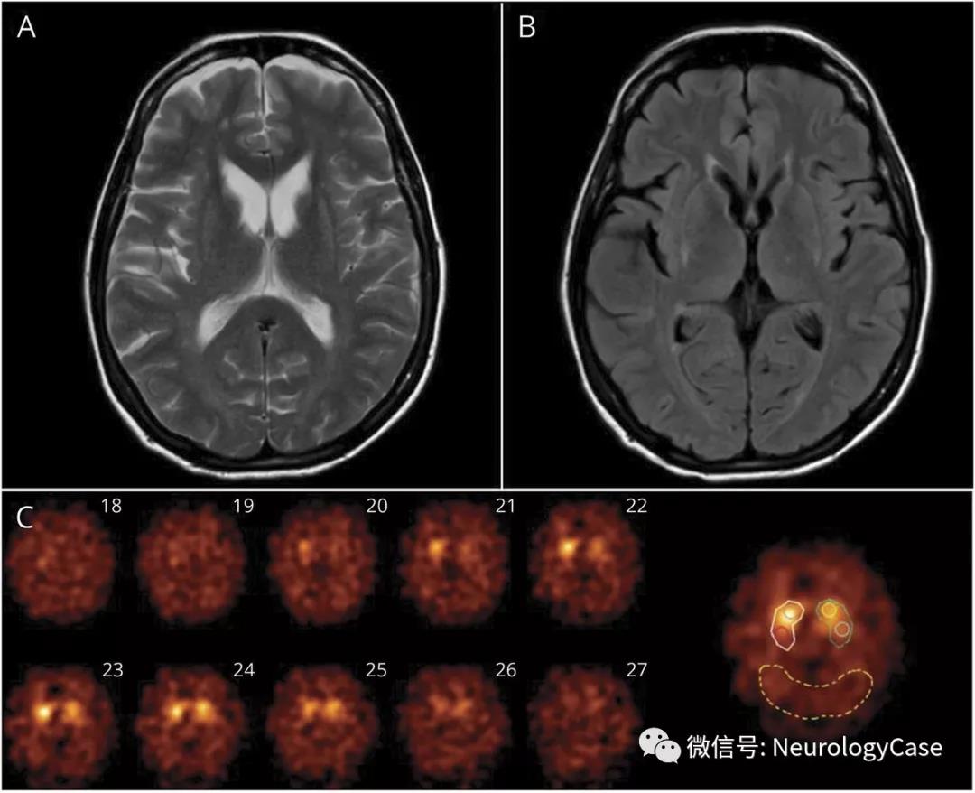 Neurology：成人GM1神经节苷脂贮积症的头颅<font color="red">MRI</font>和DaT-SPECT<font color="red">成像</font>