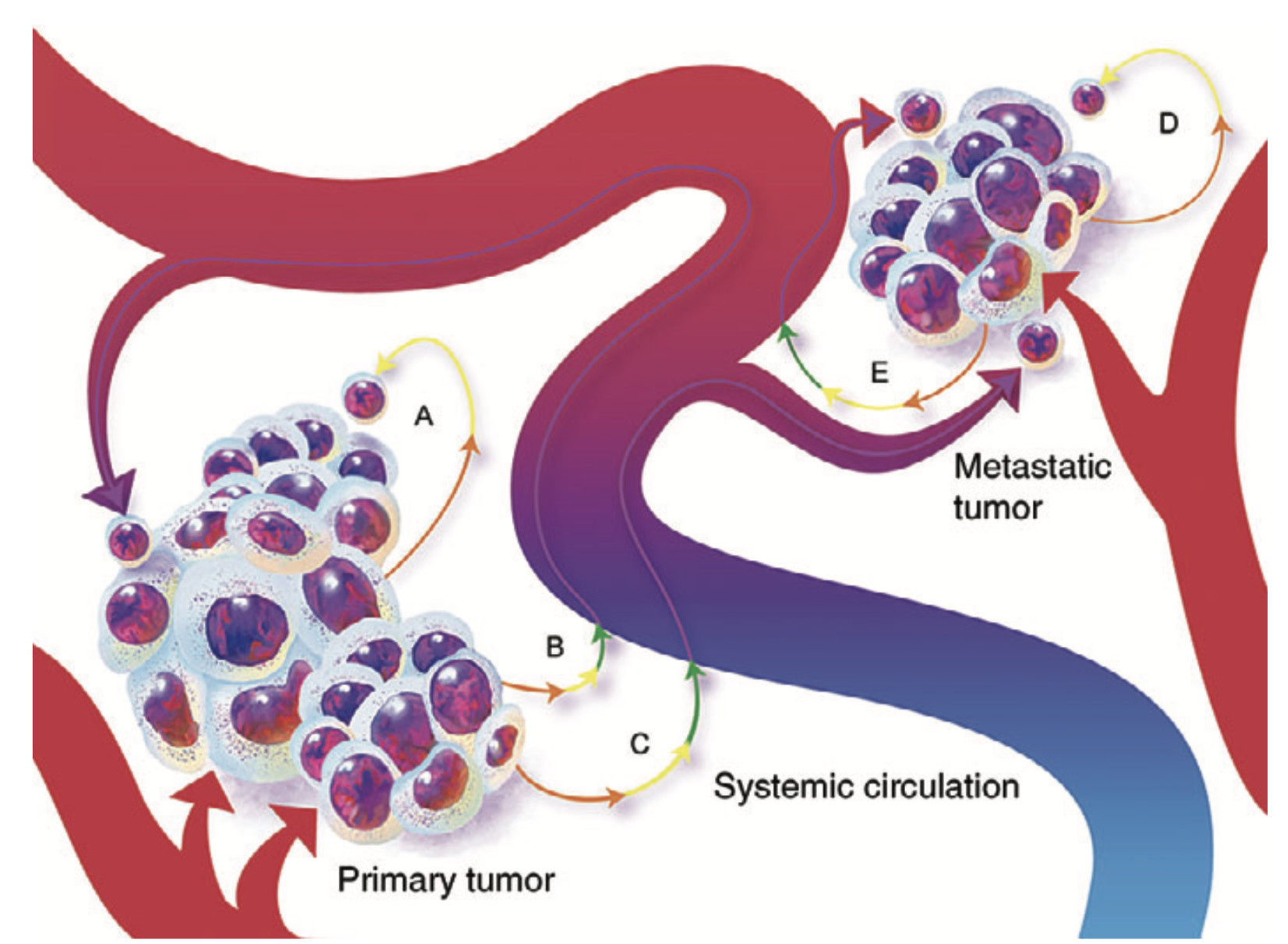 Sci Transl Med：癌细胞“大义灭亲”！哈佛科学家将癌细胞改造成冷血抗癌杀手，杀遍全身肿瘤后自杀