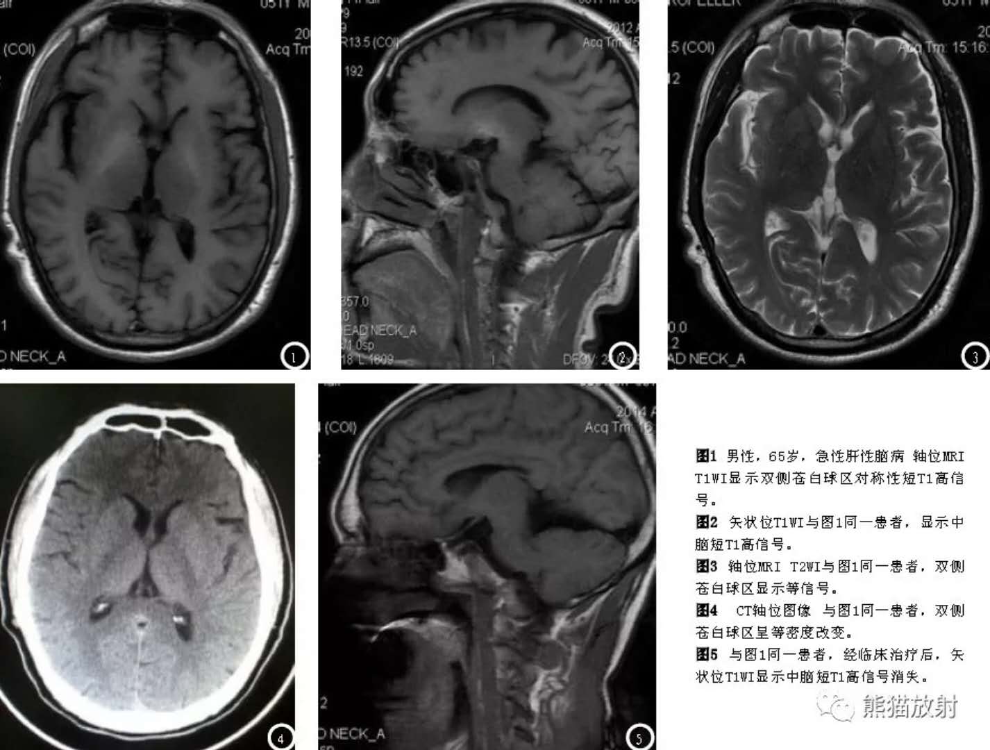 急/慢性肝性<font color="red">脑</font>病丨MRI表现